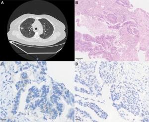 HER2-mutated NSCLC in Brazil shows diverse genetic patterns and treatment gaps HER2-mutated NSCLC in Brazil shows diverse genetic patterns and treatment gaps