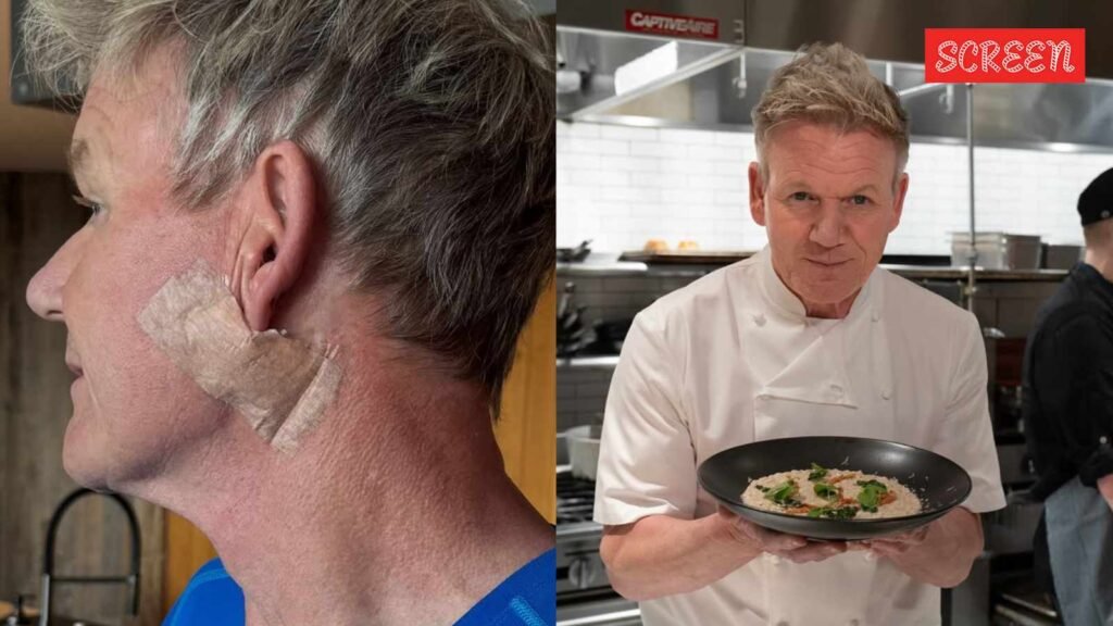 Gordon Ramsay reveals undergoing surgery for skin cancer, cautions ‘don’t forget your sunscreen’ | Hollywood News